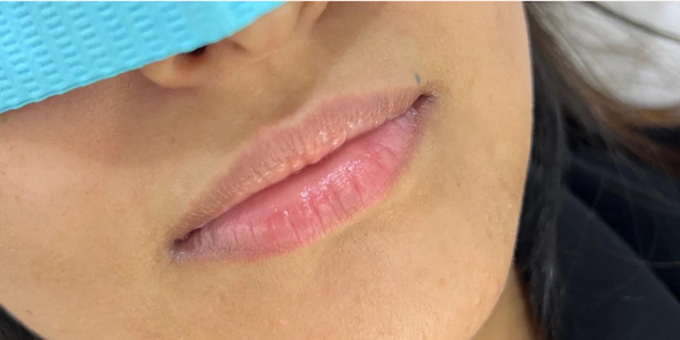 Before treatment, result 1 of 16