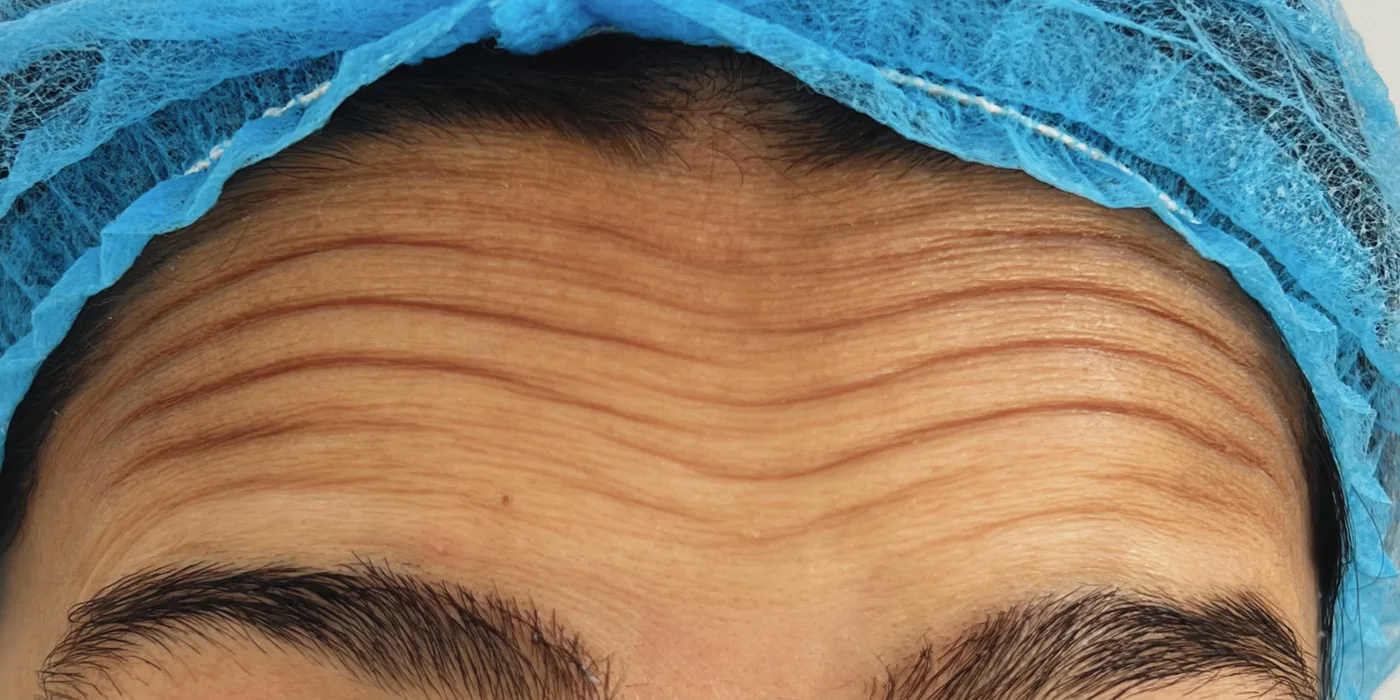 Before treatment, result 2 of 16