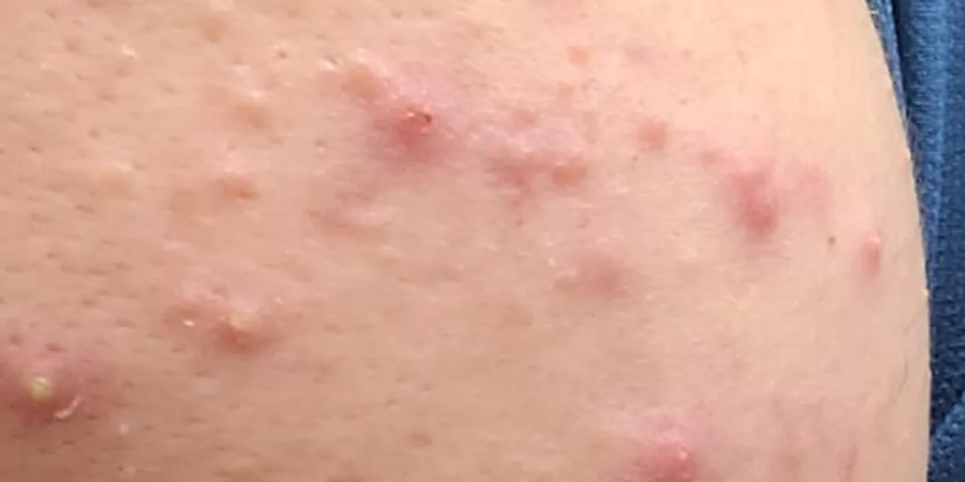 Before treatment, result 4 of 16