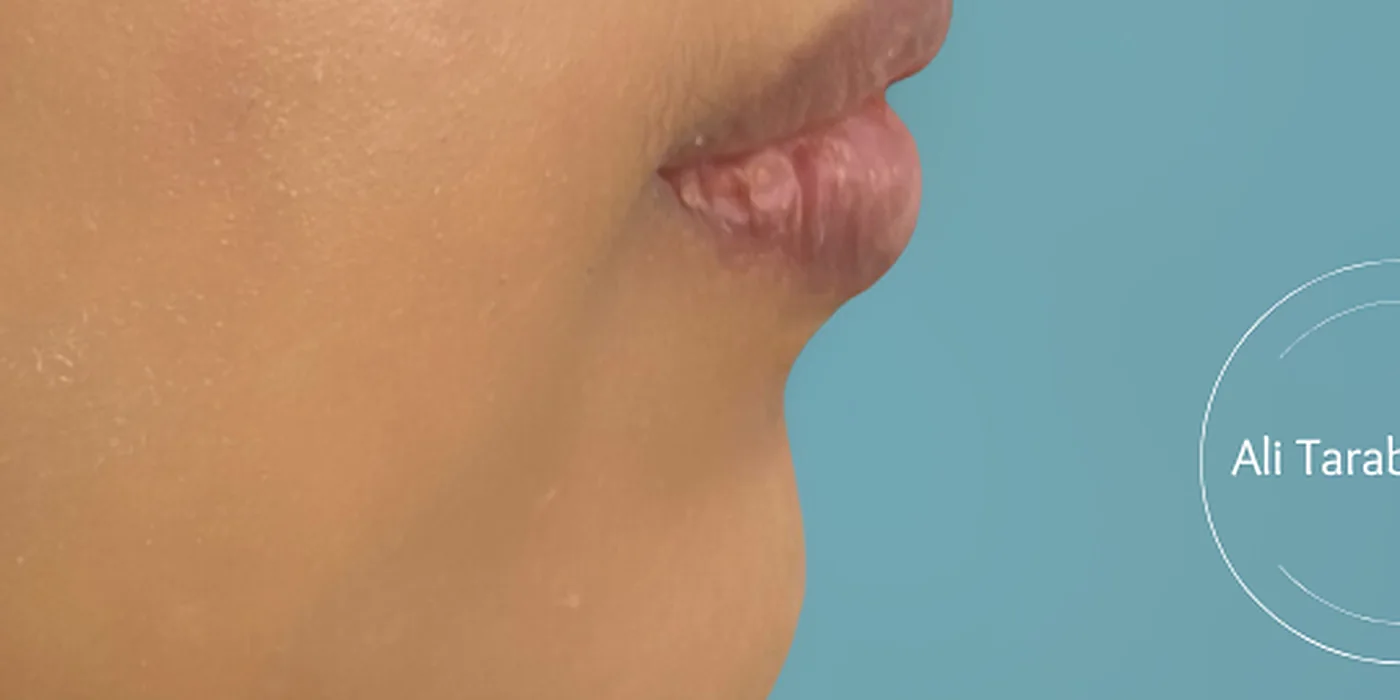 Before treatment, result 5 of 16