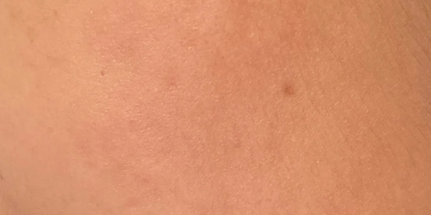 After treatment, result 6 of 16