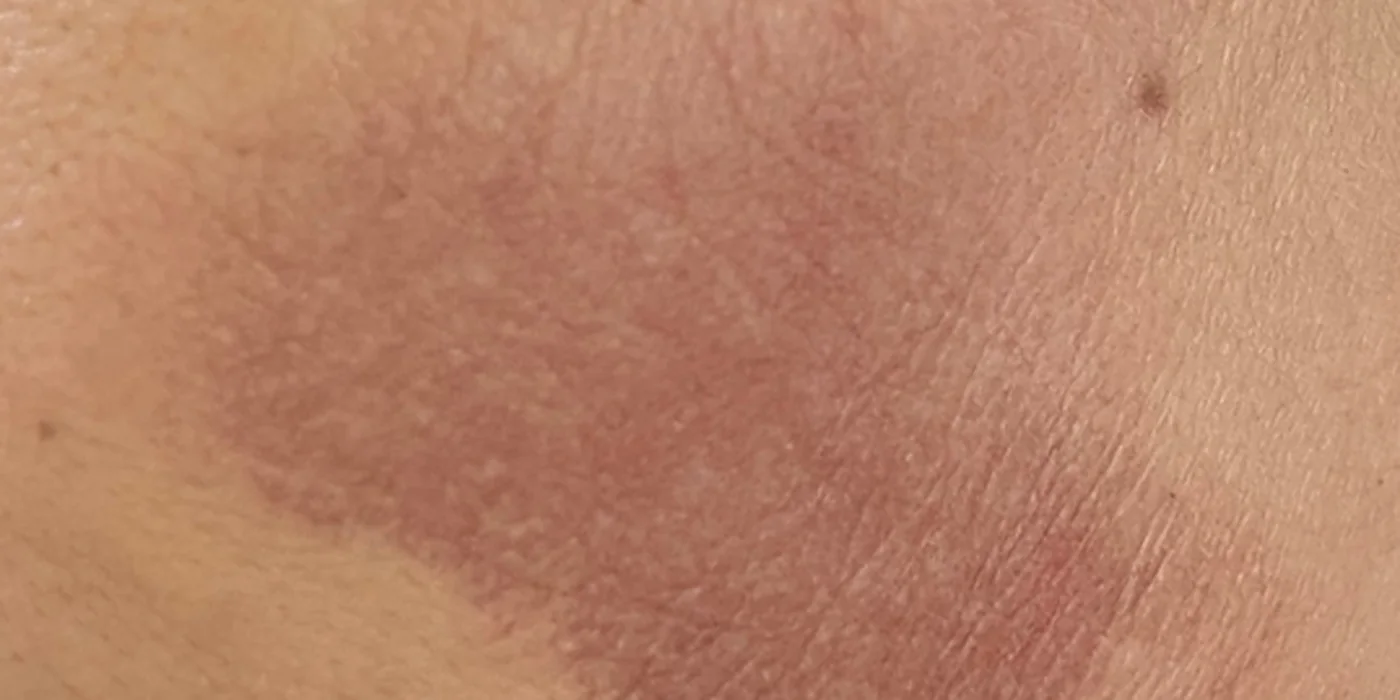Before treatment, result 6 of 16