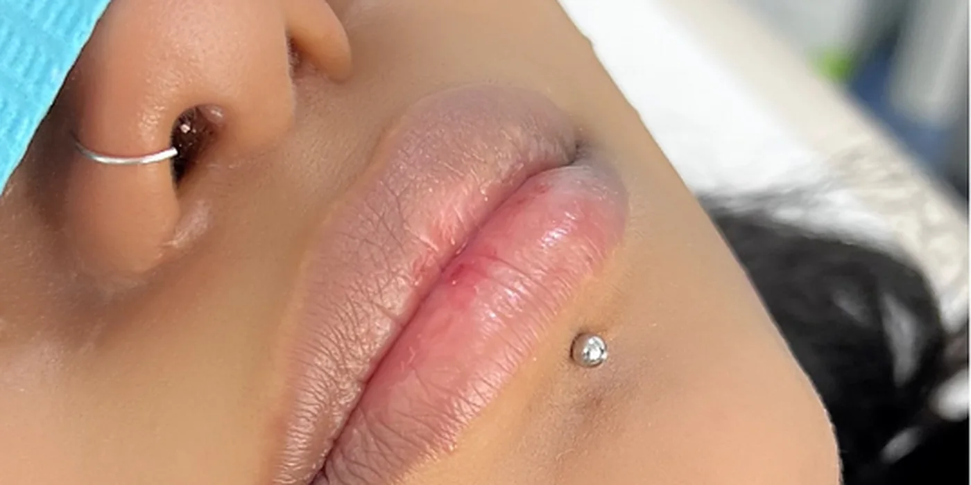 Before treatment, result 8 of 16