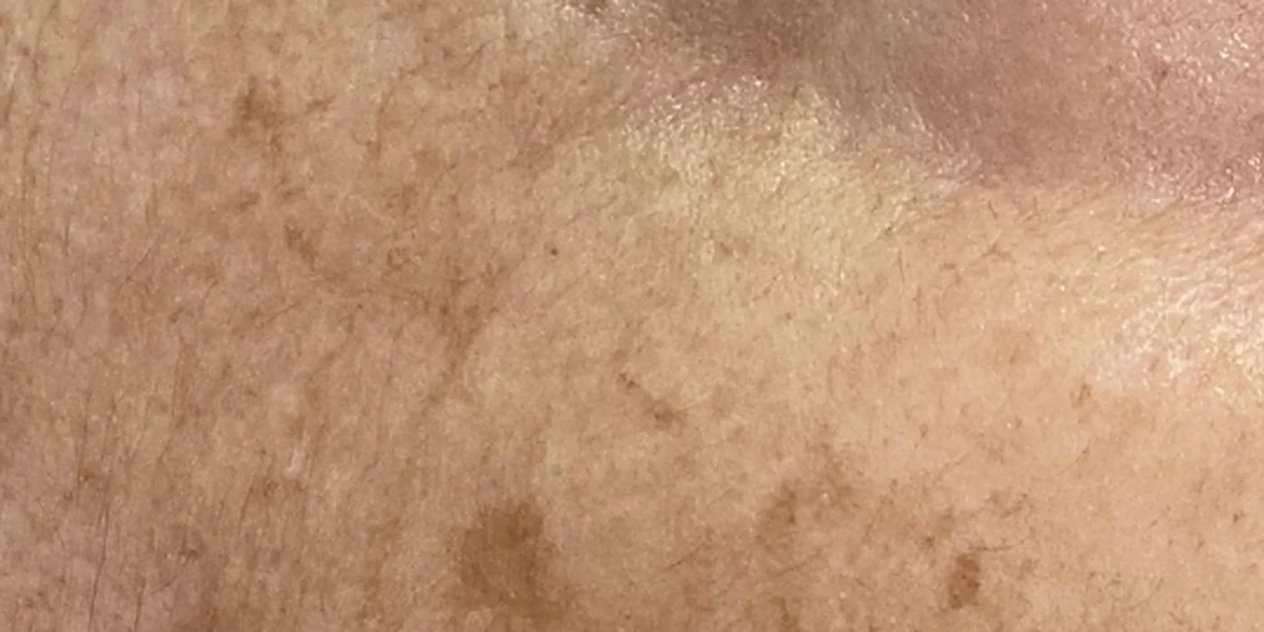 After treatment, result 9 of 16