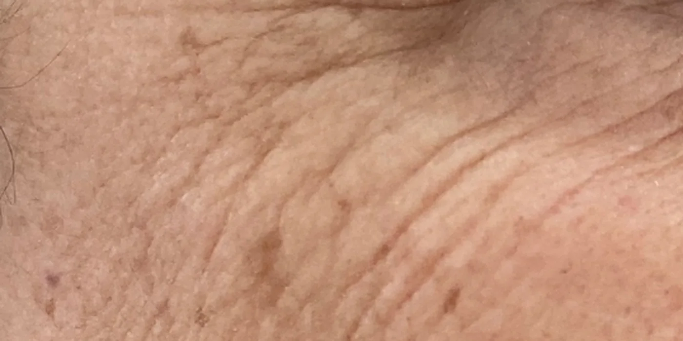 Before treatment, result 9 of 16