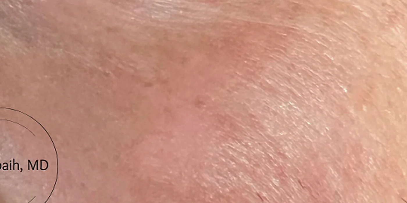 After treatment, result 10 of 16