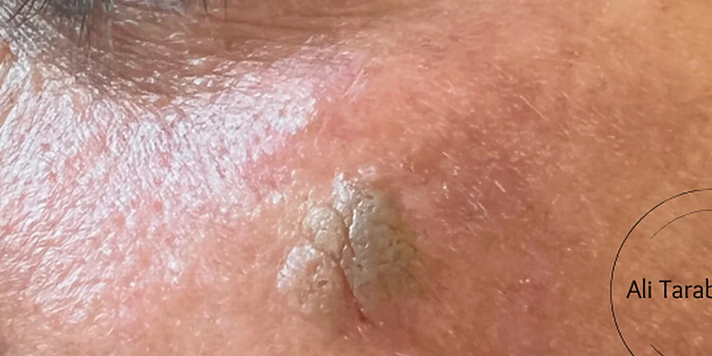 Before treatment, result 10 of 16