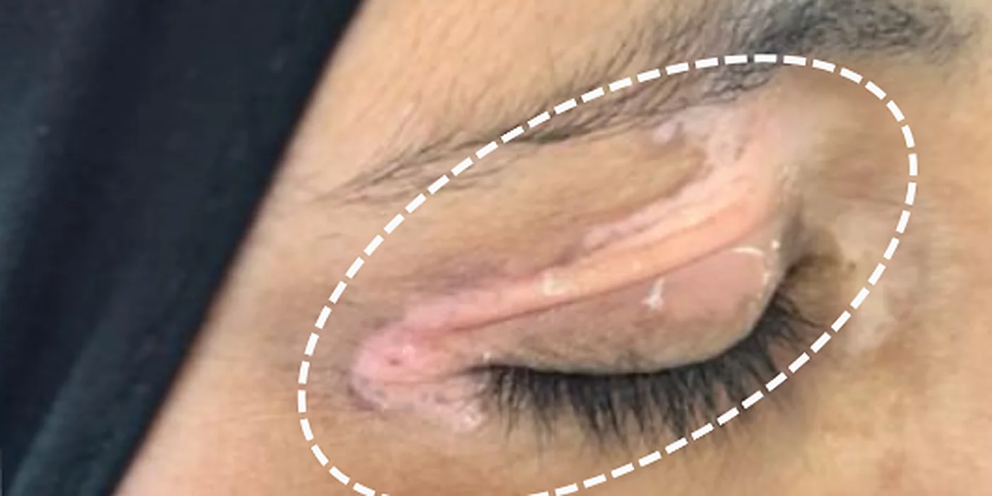 Before treatment, result 13 of 16