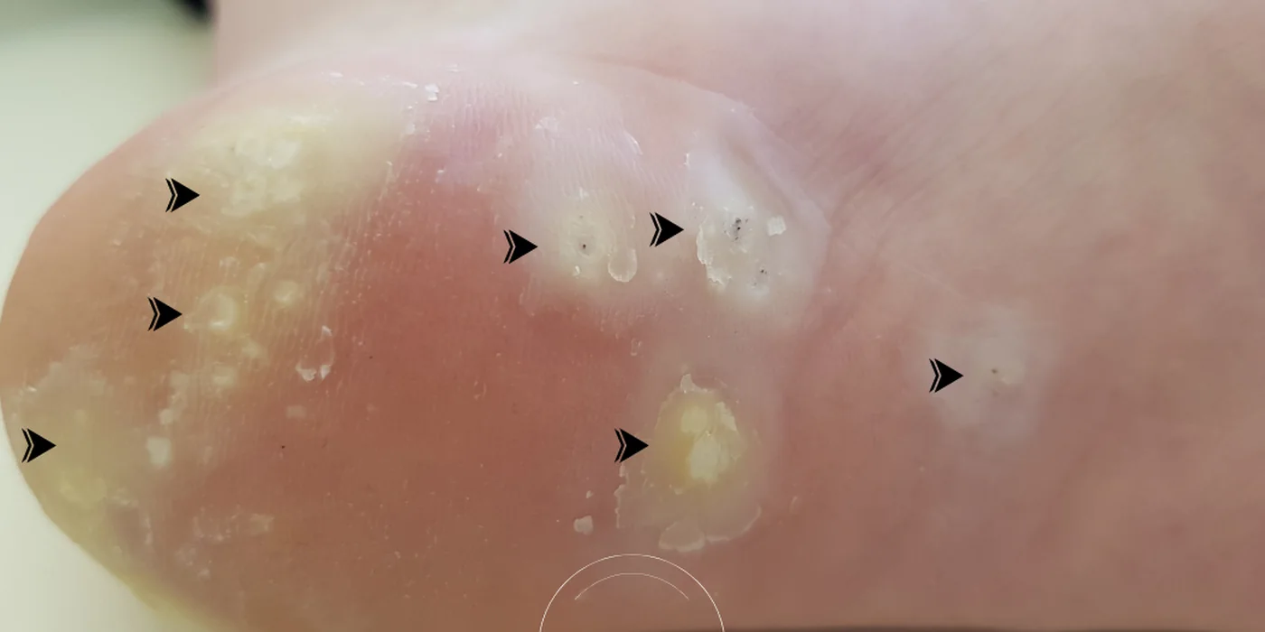 Before treatment, result 14 of 16