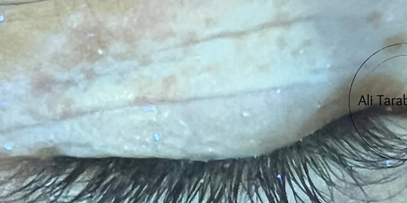 Before treatment, result 15 of 16
