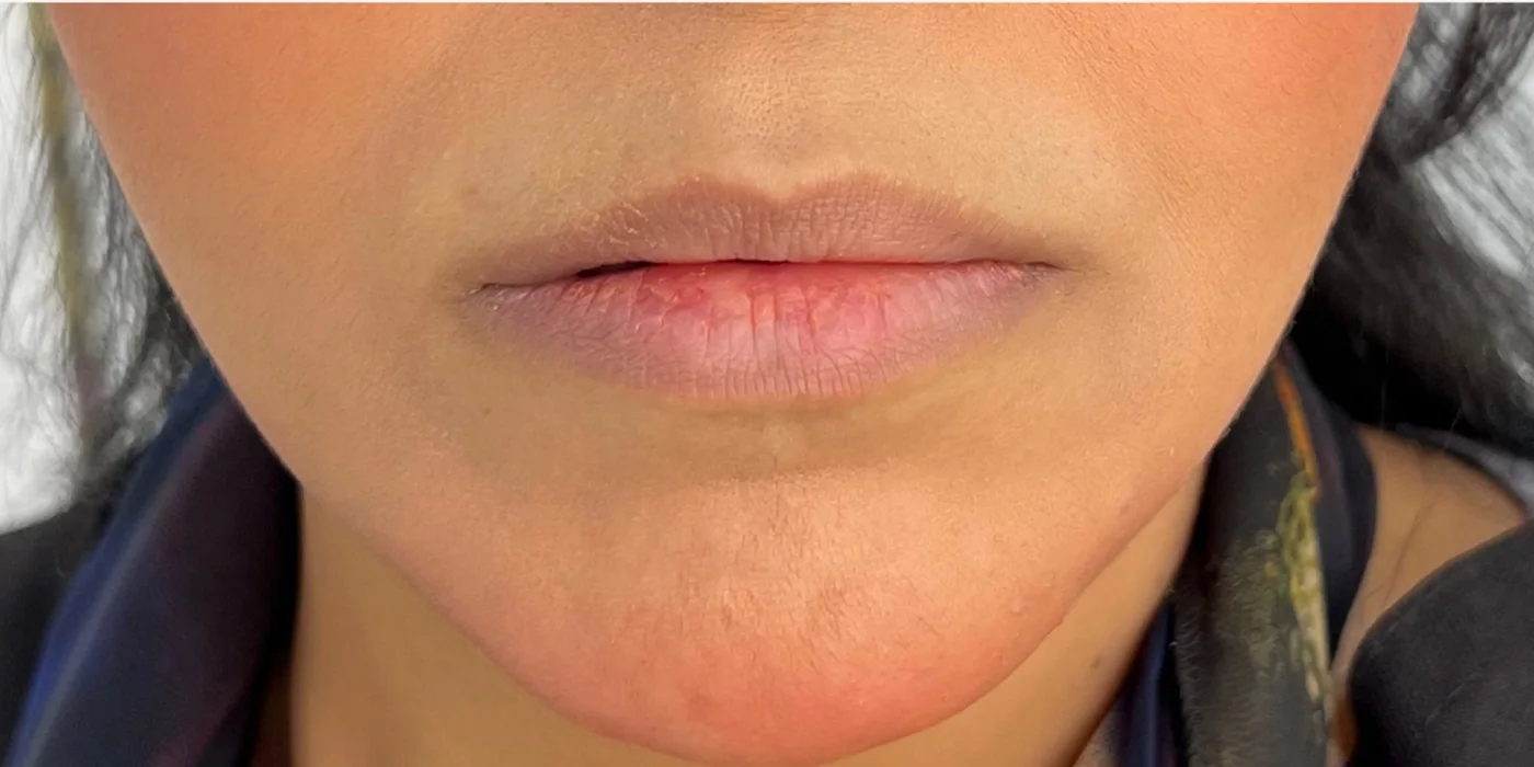 Before treatment, result 16 of 16