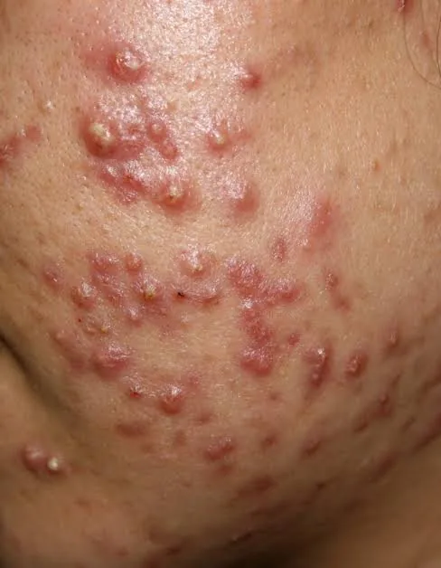 Acne