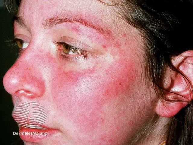 Autoimmune Skin Diseases