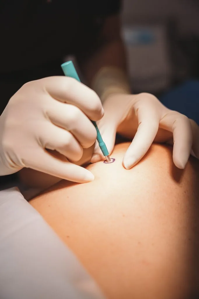 Biopsies of Skin Lesions & Tumors