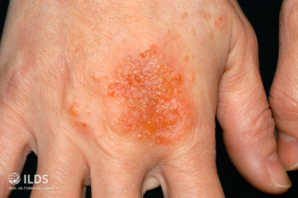 Eczema