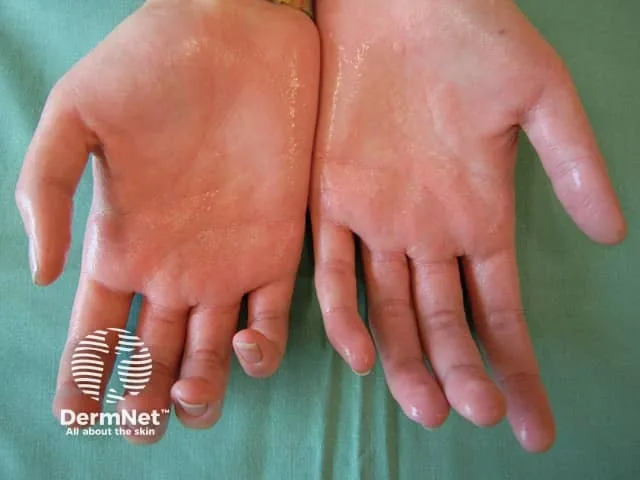 Excessive Sweating