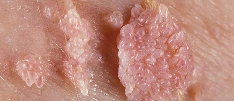 Genital Warts