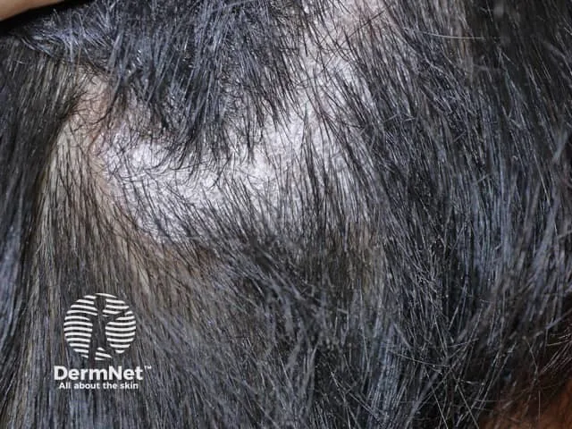 Hair & Nail Diseases