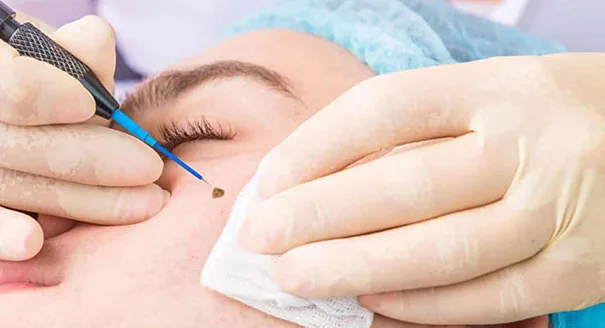 Hyfrecator (Electrocautery)