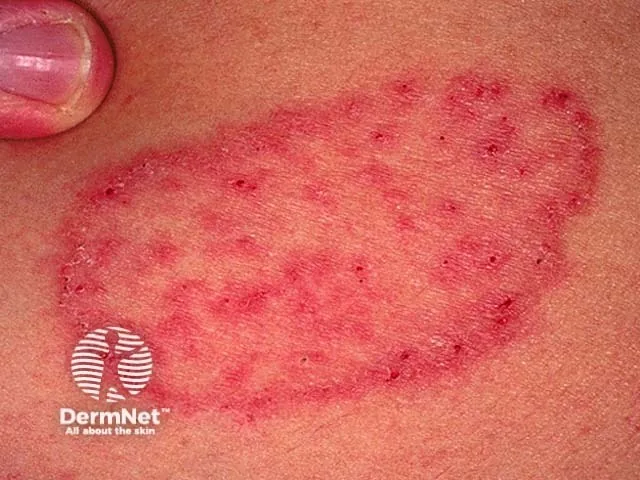 Infectious Skin Diseases