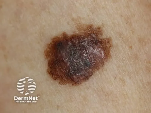 Melanoma