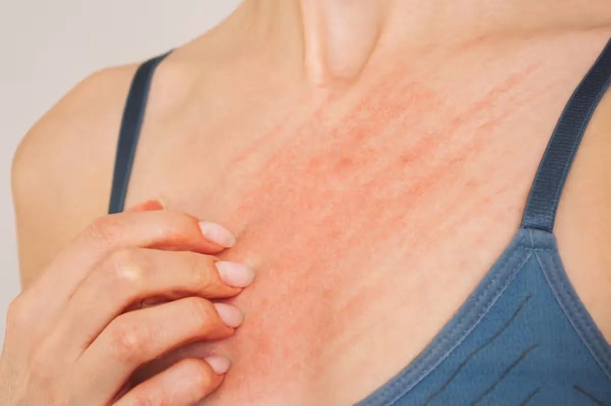 Pruritus (Itching)