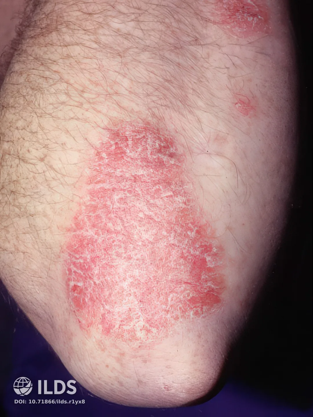 Psoriasis