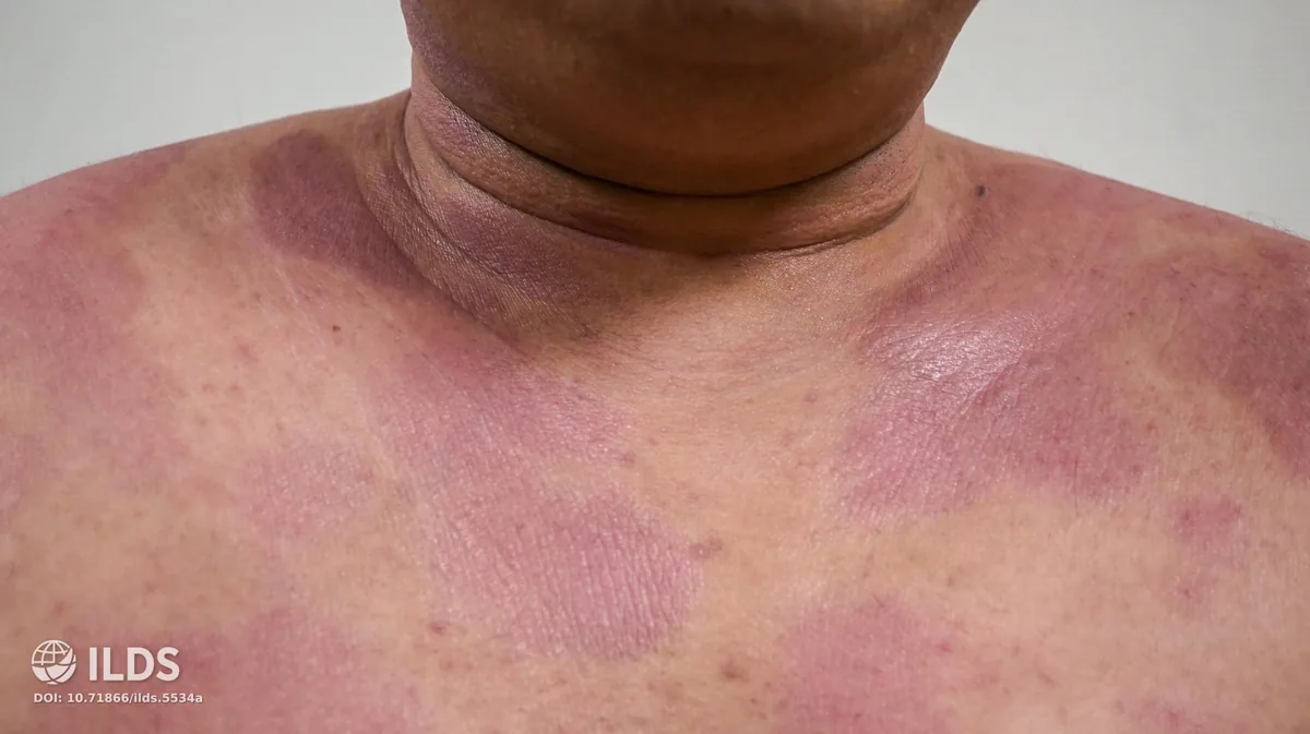 Skin Allergies