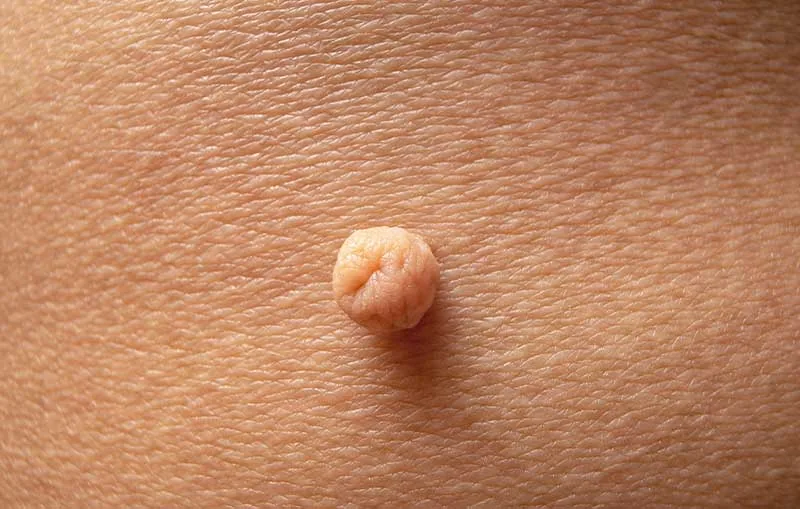 Skin Tag Removal