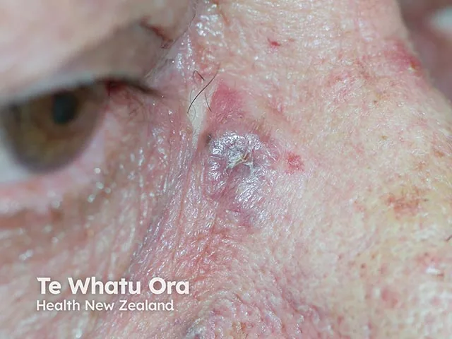 Skin Tumors
