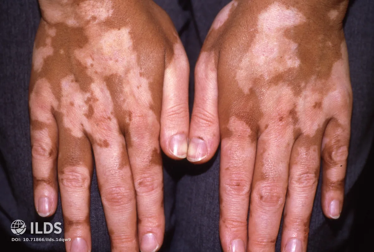 Vitiligo